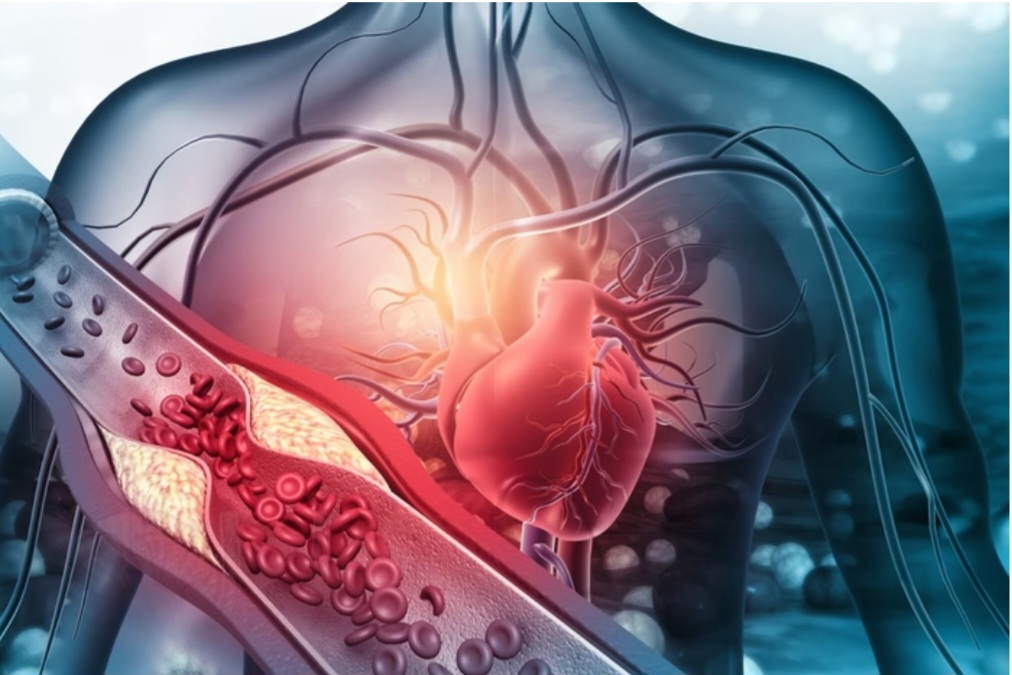Cardiologista explica a relação entre colesterol alto e hipertensão - Por Claúdia Meireles